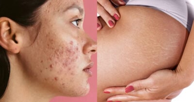 Óleo natural combate acne e espinhas (Foto: Divulgação)