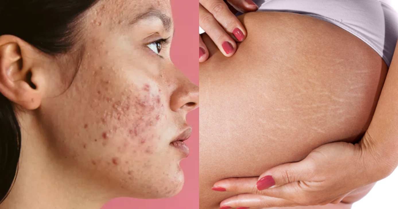 Óleo natural combate acne e espinhas (Foto: Divulgação)
