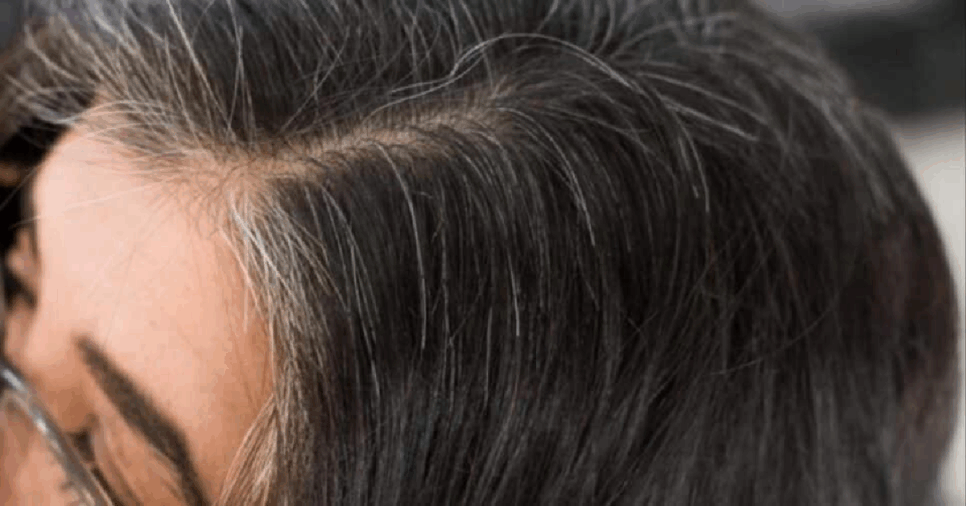 Cabelos grisalhos sumindo (Foto: Reprodução)