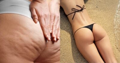 Adeus, celulite: 3 produtos de farmácia que deixam pernas lisinhas para o Verão - Montagem/TV FOCO