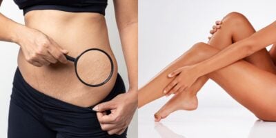 3 dicas para disfarçar as estrias no verão (Reprodução: Montagem TV Foco)