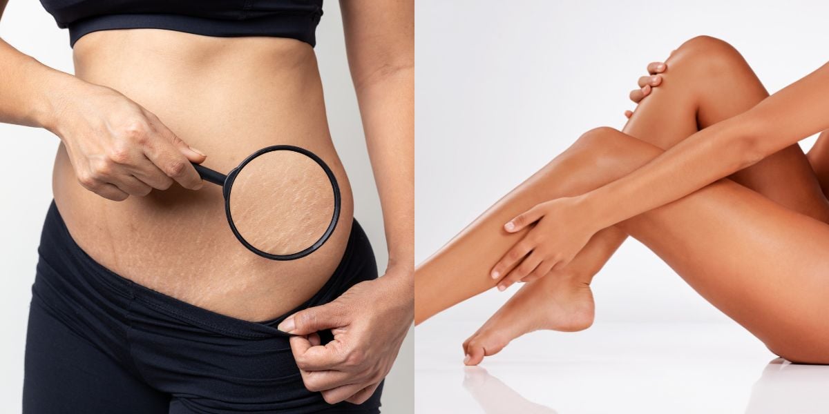 3 dicas para disfarçar as estrias no verão (Reprodução: Montagem TV Foco)