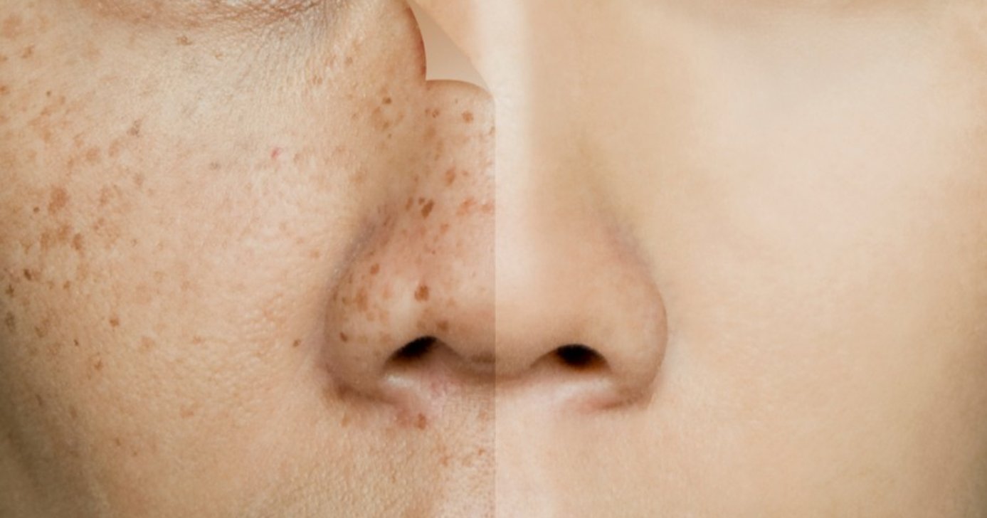 Forma natural de eliminar manchas na pele (Foto: Divulgação)