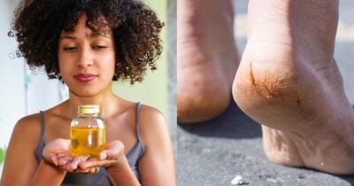 Óleo natural deixa pele hidratada e acaba com as rachaduras ds pés - Montagem/TV FOCO