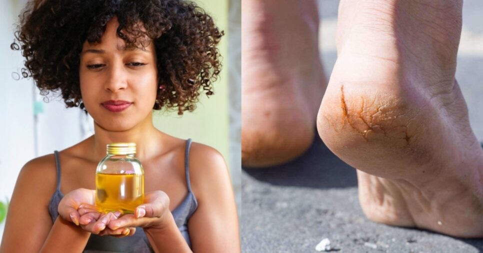 Óleo natural deixa pele hidratada e acaba com as rachaduras ds pés - Montagem/TV FOCO