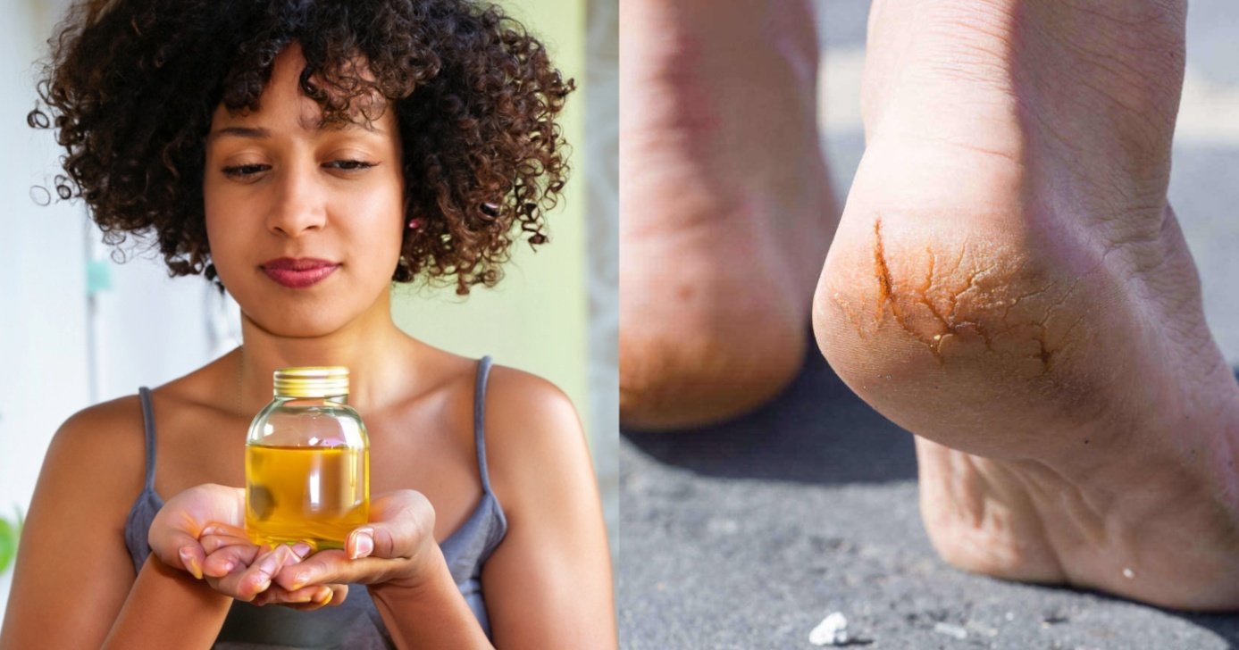 Óleo natural deixa pele hidratada e acaba com as rachaduras ds pés - Montagem/TV FOCO