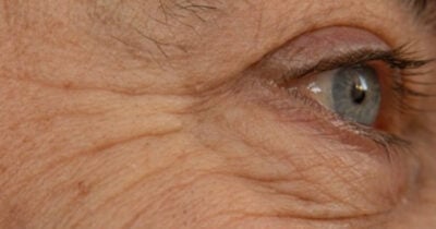 Como acabar com as rugas de verdade (Foto: Divulgação)