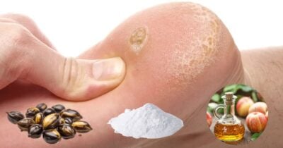 8 remédios caseiros eficientes para acabar com calos e aliviar o desconforto (Foto Reprodução/Montagem/TV Foco/Canva/Paola)