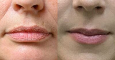 Blend poderoso: Mistura de 3 óleos elimina o bigode chinês e linhas finas (Foto Reprodução/Montagem/TV Foco/Canva/Paola)