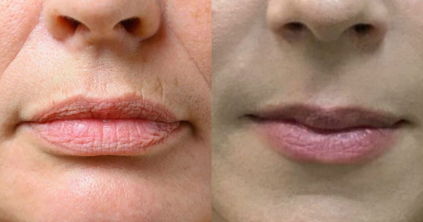 Blend poderoso: Mistura de 3 óleos elimina o bigode chinês e linhas finas (Foto Reprodução/Montagem/TV Foco/Canva/Paola)