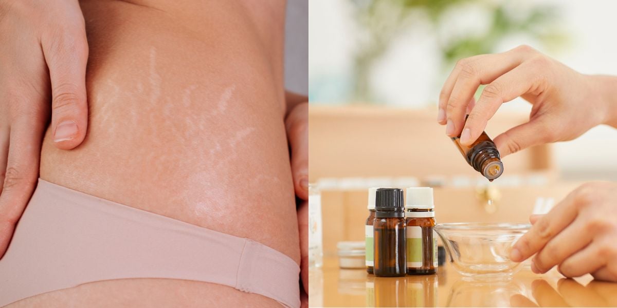 2 óleos para acabar com as estrias e varizes (Reprodução: Montagem TV Foco)