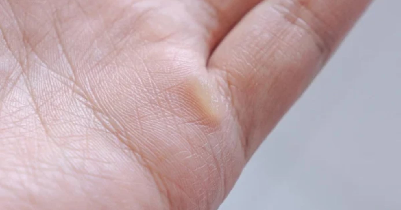 Como eliminar calos das mãos (Foto: Divulgação)