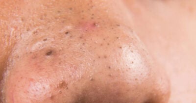 Cravos podem chegar ao fim com essas dicas (Foto: Divulgação)