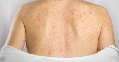 Espinhas nas costas (Foto: Divulgação)