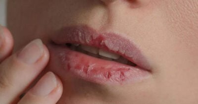 Lábios rachados (Foto: Divulgação)