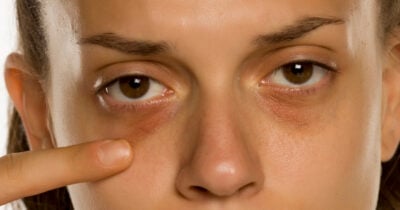 Como tratar olheiras (Foto: Divulgação)