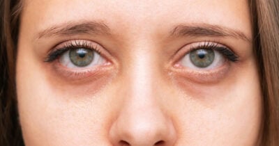 Olheiras podem chegar ao fim com essas 5 dicas (Foto: Divulgação)