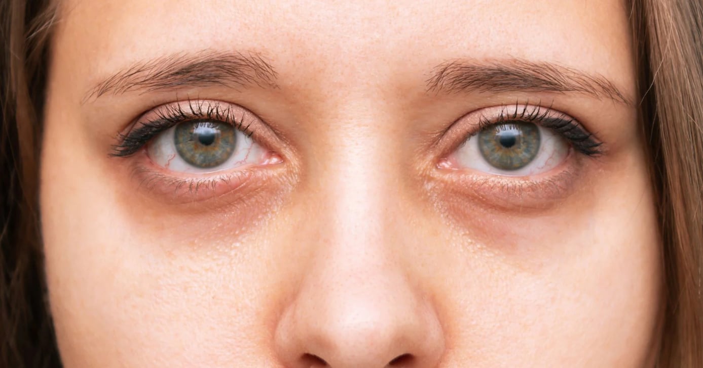 Olheiras podem chegar ao fim com essas 5 dicas (Foto: Divulgação)