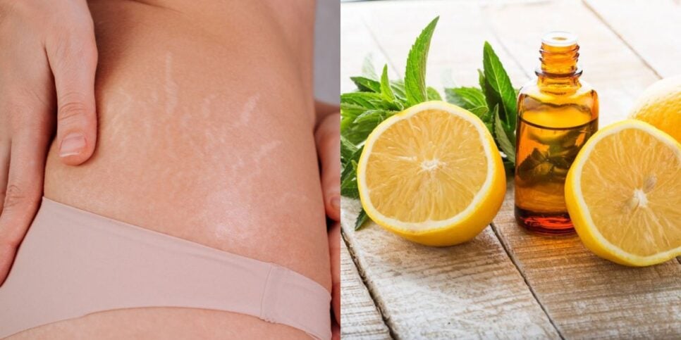 Óleo de limão ajuda a disfarçar as estrias (Reprodução: Montagem TV Foco)