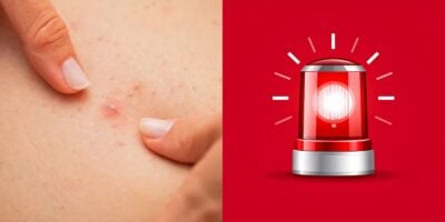 3 hábitos que aumentam a chance de ter pelo encravado (Reprodução: Montagem TV Foco)