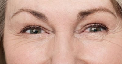 Como acabar com os pés de galinha (Foto: Divulgação)