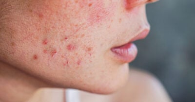 Esses são os 5 vilões que estão causando espinhas (Foto: Divulgação)