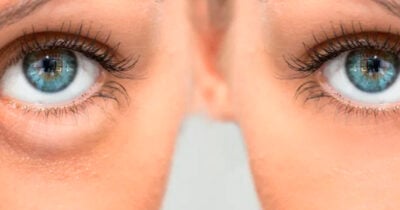 Os 5 segredos para acabar com as olheiras (Foto: Divulgação)