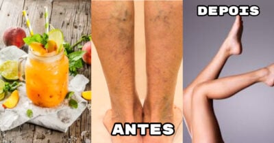 Veja como preparar o suco popular que ajuda a reduzir manchas e varizes (Foto: Divulgação)