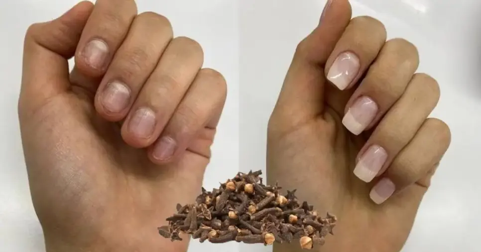Como fazer solução caseira com cravo para ter unhas fortes e longas e se livrar do gasto no salão (Foto Reprodução/Montagem/TV Foco/Canva/Paola) Como fazer solução caseira com cravo para ter unhas fortes e longas e se livrar do gasto no salão (Foto Reprodução/Montagem/TV Foco/Canva/Paola)