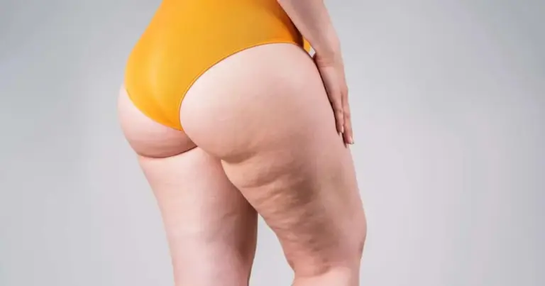 Pele lisa antes do verão: 3 produtos que ajudam a reduzir a celulite Pele lisa antes do verão: 3 produtos que ajudam a reduzir a celulite