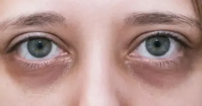Coloque esse chá popular nos olhos e suma com olheiras e aspecto de cansada sem procedimentos