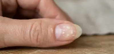 Unhas com manchas brancas: Quais são as causas e como fazer para tratar