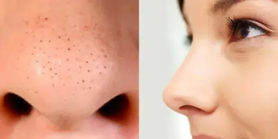 Guia prático: Como eliminar os cravos do nariz com 3 produtos acessíveis