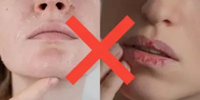 Não precisa de creme hidratante: Como evitar lábios rachados e pele seca no frio com 1 ingrediente natural