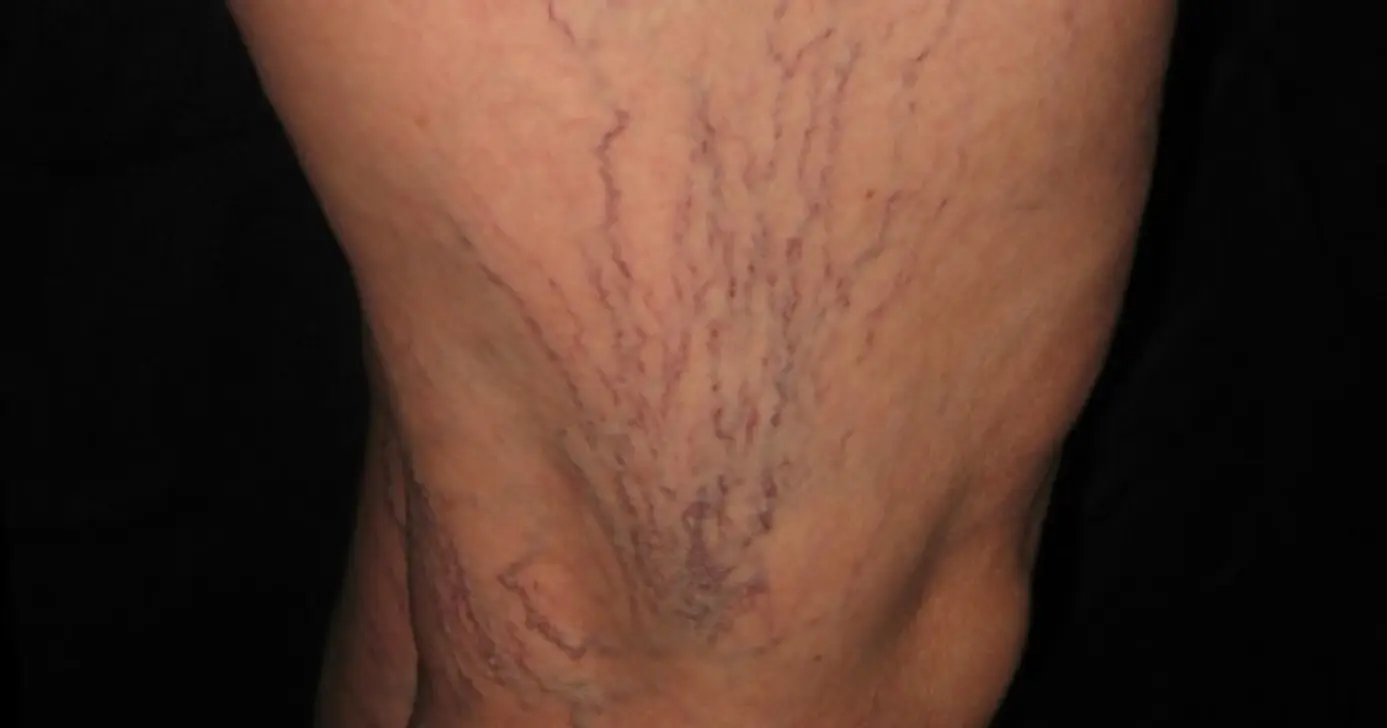 Elimine varizes com essas dicas (Foto: Divulgação)