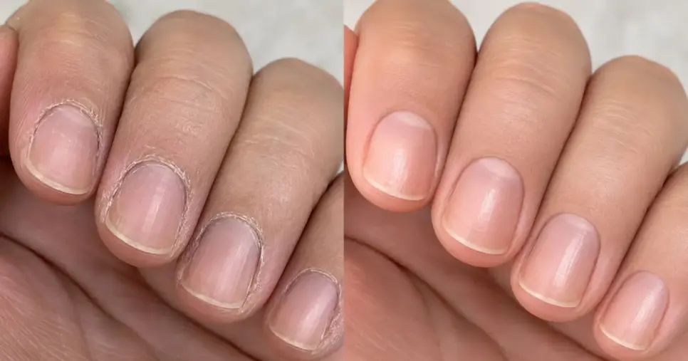 Cutículas ressecadas antes e depois (Foto: Reprodução/Internet)