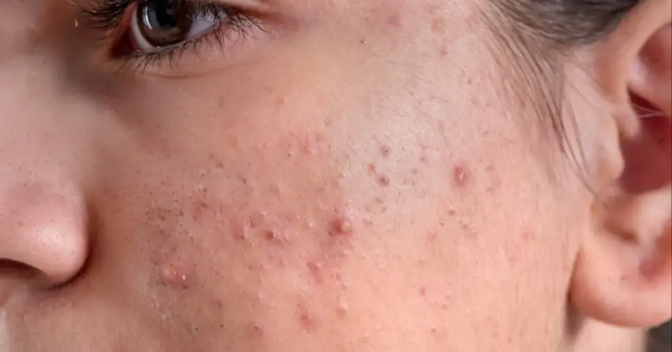 Tratamento natural caseiro reduz a acne e deixa a pele mais bonita (Foto: Reprodução/Internet) Tratamento natural caseiro reduz a acne e deixa a pele mais bonita (Foto: Reprodução/Internet)