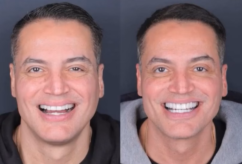 Antes e depois do sorriso de Leo Dias (Foto: Reprodução / YouTube)