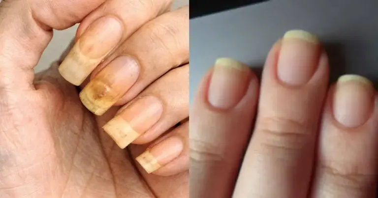Manchas amarelas nas unhas: Truque com vinagre corrige problema
