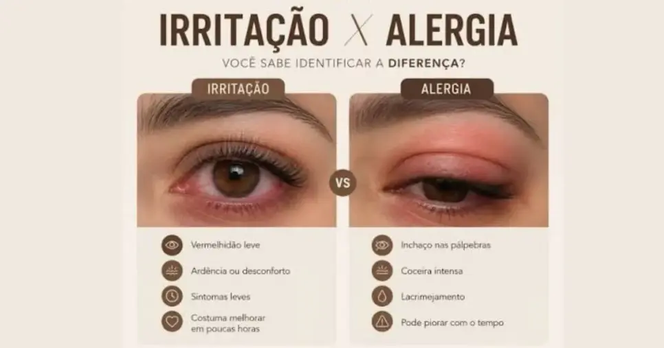 Diferença de alergia e irritação (Foto Reprodução/Instagram) Diferença de alergia e irritação (Foto Reprodução/Instagram)