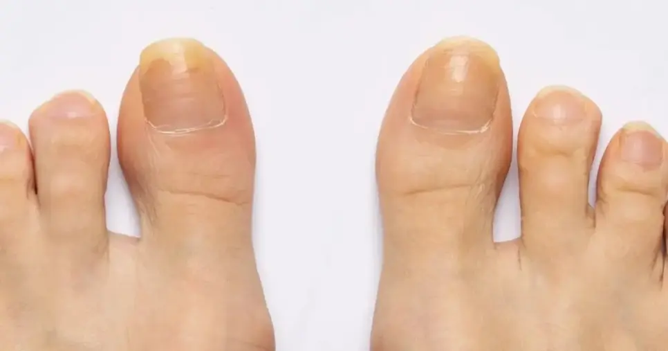 Unhas dos pés sem esmaltes (Foto: Reprodução/ Internet) Unhas dos pés sem esmaltes (Foto: Reprodução/ Internet)