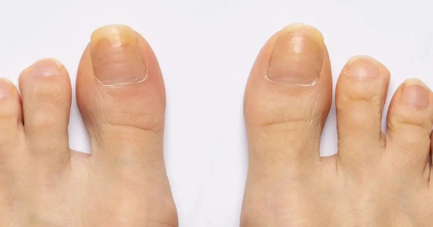 Unhas dos pés sem esmaltes (Foto: Reprodução/ Internet)
