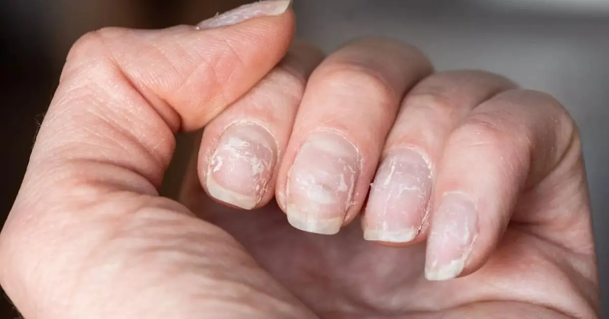 Unhas descamando (Foto: Reprodução)