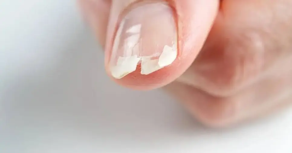 Unhas descamando (Foto: Reprodução) Unhas descamando (Foto: Reprodução)