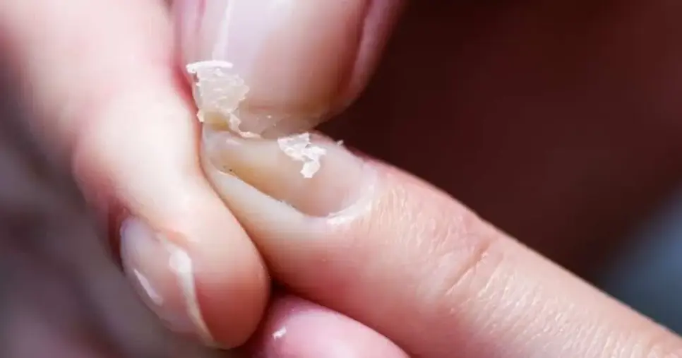 Unhas descamando (Foto: Reprodução) Unhas descamando (Foto: Reprodução)