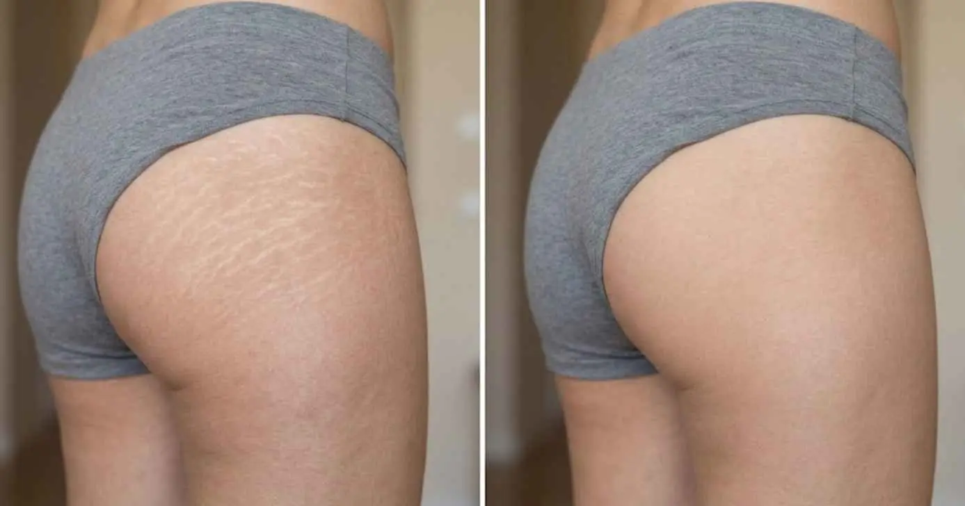Ilustração antes e depois de estrias (Foto: Montagem TV Foco / GMN)