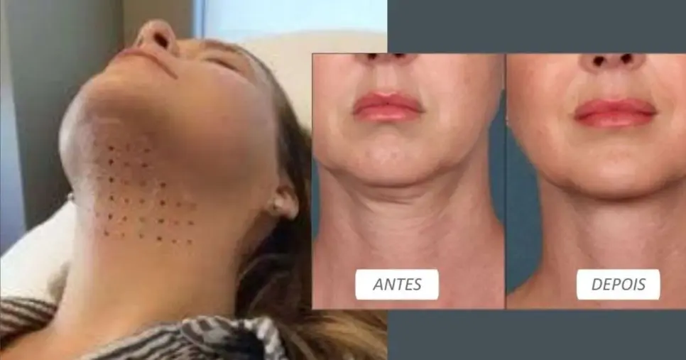 Aplicação de ácido na papada/antes e depois (Foto Reprodução/Montagem/Lennita/Pinterest) Aplicação de ácido na papada/antes e depois (Foto Reprodução/Montagem/Lennita/Pinterest)