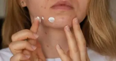 Espinha: 1 produto ajuda a prevenir manchas e marcas na pele