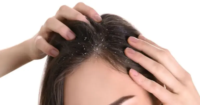 Fim da caspa: Como salvar o couro cabeludo com 3 ingredientes populares Fim da caspa: Como salvar o couro cabeludo com 3 ingredientes populares